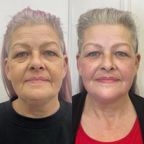 IPL skin rejuvenation session
