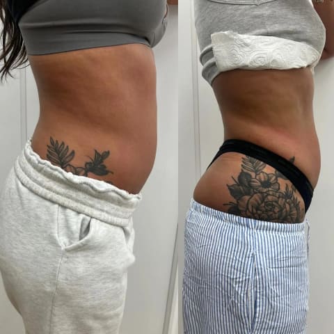 Radio frequency skin tightening with dermaplaning