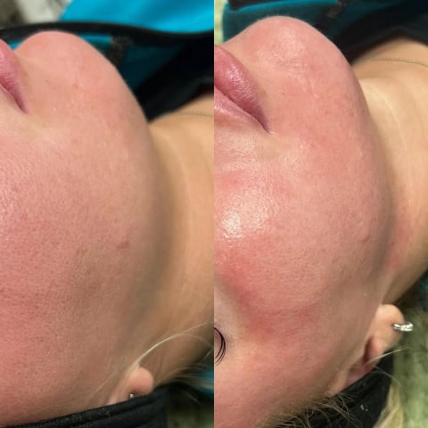Advanced facial treatment at SKYN