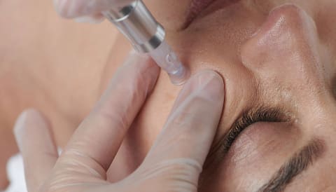 Microneedling facial treatment