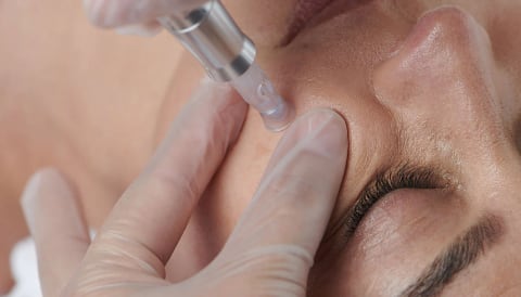 Microneedling facial treatment